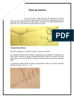 Tipos de Sutura