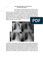 Caso de Neumotorax