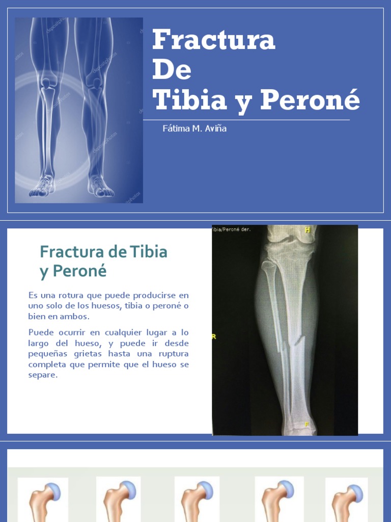 Fractura de Tibia y Peroné | PDF