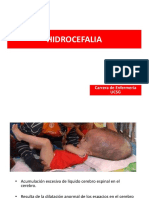 Hidrocefalia 130313180513 Phpapp01
