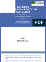 Referat Pneumonia Rizky Alif