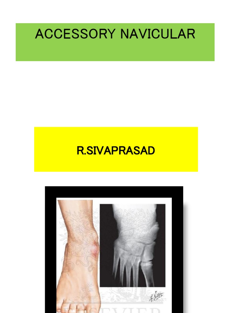 Accessory Navicular PDF Foot Anatomical Terms Of Location