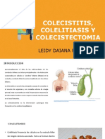 Colecistitis, Colelitiasis y Colecistectomia