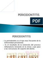 PERIODONTITIS