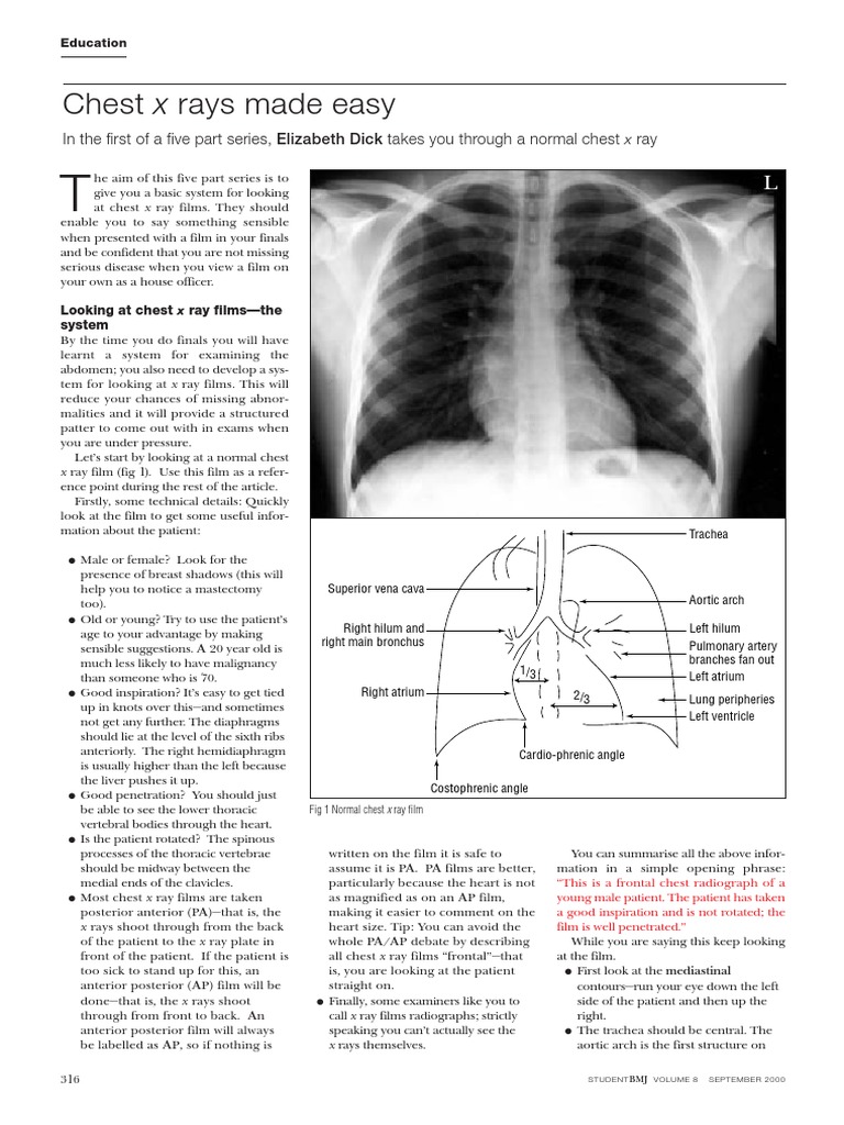 Chest X-Ray Interpretation Simplified | PDF | Lung | Thorax
