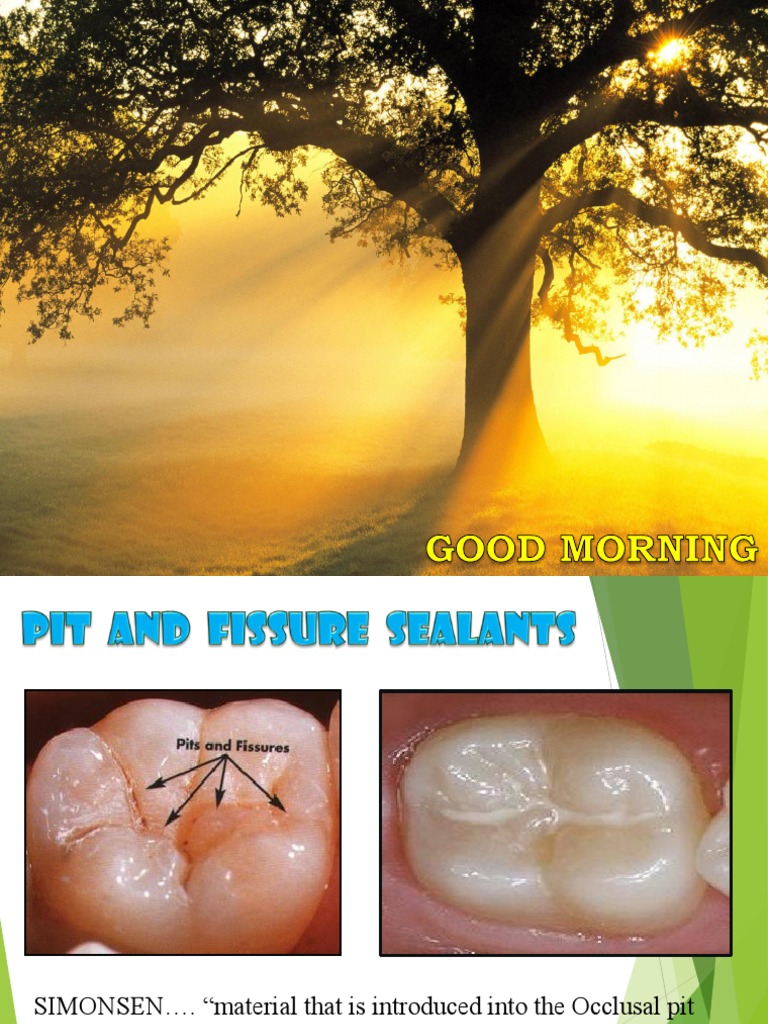 Pit and Fissure Sealant PDF Dentistry Mouth