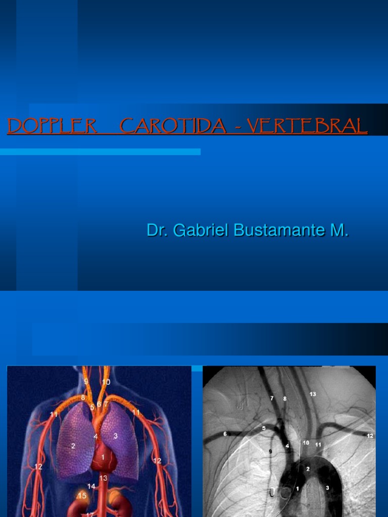 DOPPLER CAROTIDA - VERTEBRAL.ppt | Fisiología | Sistema cardiovascular