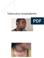 1.tuberculous Lymphadenitis