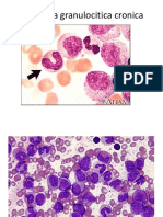 Leucemia Granulocitica Cronica