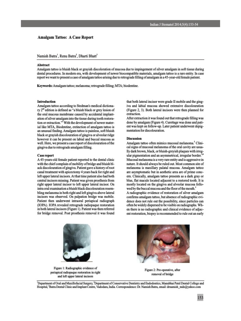 Case Report Amalgam Tattoo PDF Dentistry Mouth