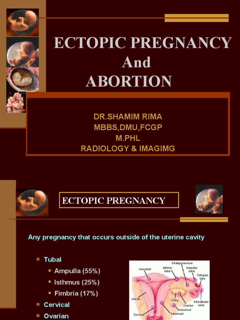 Ectopic Pregnancy and Abortion: DR - Shamim Rima MBBS, Dmu, FCGP M.PHL