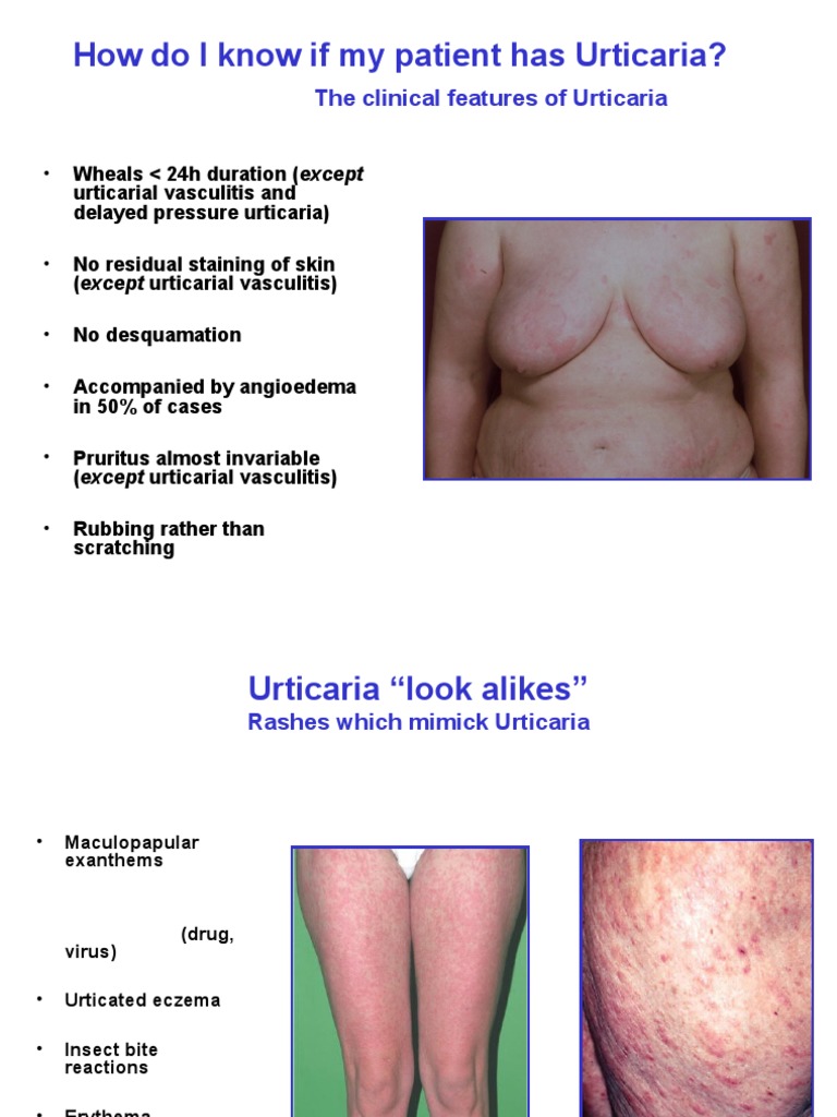 Urticaria Diagnosis and Treatment Guide | PDF | Medical Treatments ...