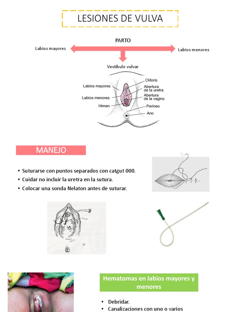 manejo-de-lesiones-en-la-vulva-y-vagina-pdf-parto-vagina