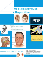 Síndrome de RAMSAY HUNT