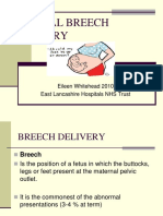 BREECH DELIVERY-2.pdf