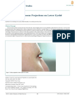 Long Cutaneous Projections on Lower Eyelid 96