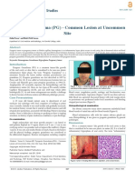 Pyogenic Granuloma Pg Common Lesion at Uncommon Site 170