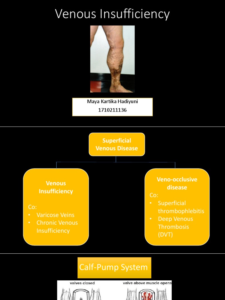 IVC | PDF