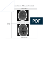 Tabel Perubahan Gambaran CT Scan Pada Stroke Iskemik