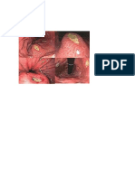 Ulcera Peptica Imagen