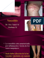 Vasculitis generalizada