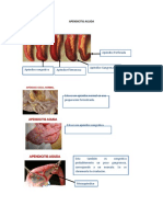 Apéndice: anatomía, historia y tratamiento de la apendicitis aguda