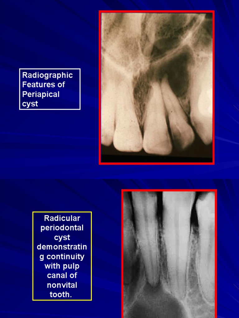 Radiographic Features of Cysts | PDF