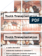 5 Tooth Transplantation