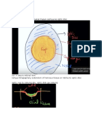 glaucoma