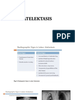 Atelektasis