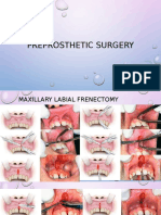 Periprosthetic Surgery