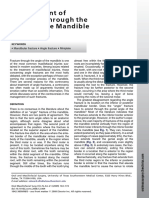 Management of Fractures Through The Angle Mandible