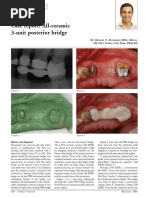 All-Ceramic 3-Unit Posterior Bridge PDF