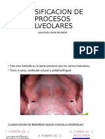 Clasificacion de Procesos Alveolares