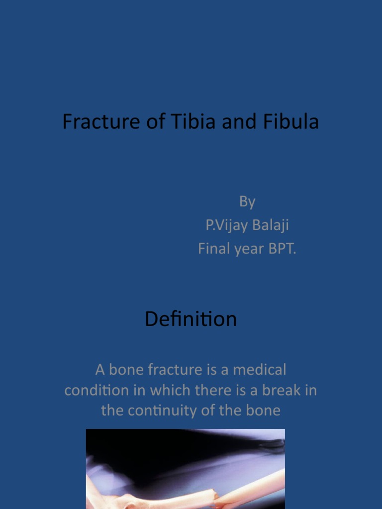 Fracture of Tibia and Fibula | PDF | Physical Therapy | Bone