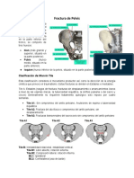 Fractura de Pelvis