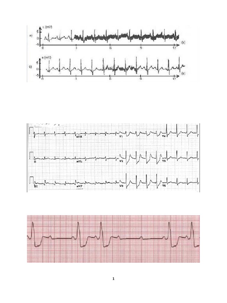 Ekg Primjeri | PDF