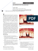 Ental Echnology: Direct Core Buildup Using A Preformed Crown and Prefabricated Zirconium Oxide Post