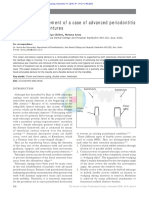 Prosthetic Management of A Case of Advanced Periodontitis With Telescopic Dentures