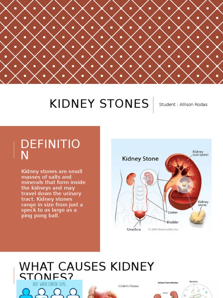 Understanding Kidney Stones: Causes & Treatment | PDF