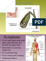 Gallstones PD - 9