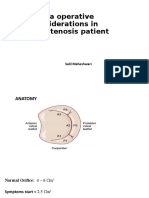 Intra Operative Considerations in Mitral Stenosis Patient: Salil Maheshwari