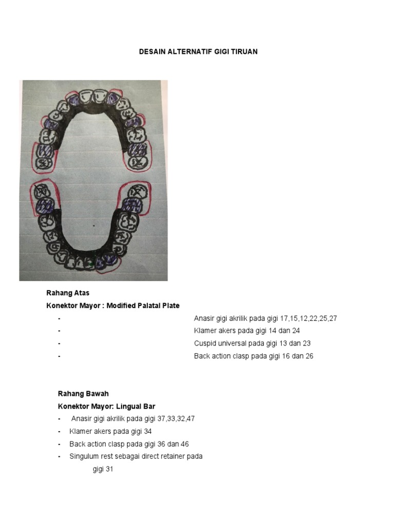 Desain Alternatif Gigi Tiruan | PDF