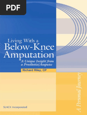 Living With A Below Knee Amputation A Unique Insight From A Prosthetist Amputee 2005 Prosthesis Amputation