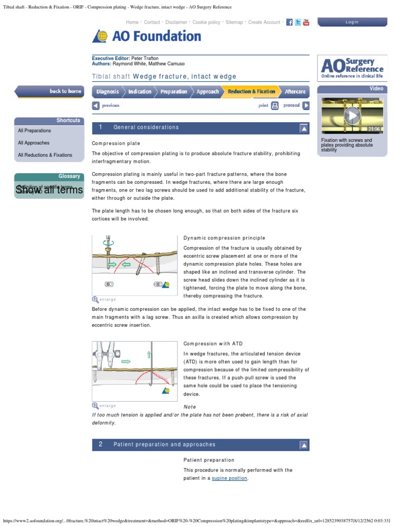 Tibial Shaft - Reduction Fixation - ORIF - Compression Plating - Wedge ...