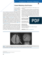 Insights and Images: Vascular Channel Mimicking A Skull Fracture