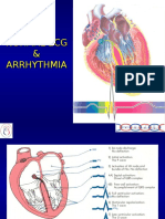 ECG Arrhythmia