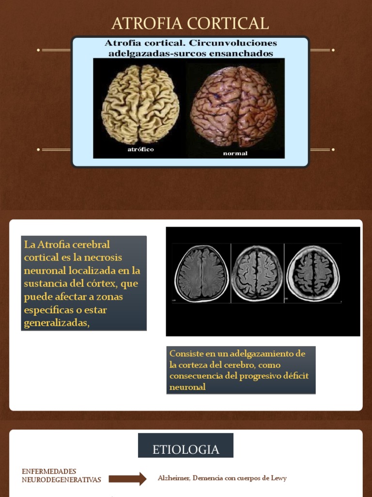 Atrofia Cortical: Causas y Síntomas | PDF | Enfermedad de Alzheimer