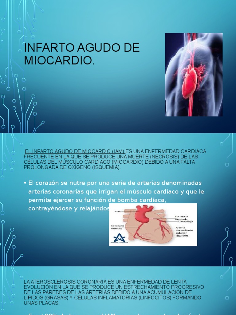 Infarto Agudo de Miocardio: Síntomas y Causas | PDF | Infarto de ...