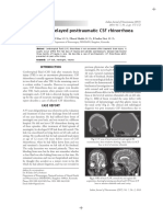 Unusually Delayed Posttraumatic CSF Rhinorrhoea: Case Report